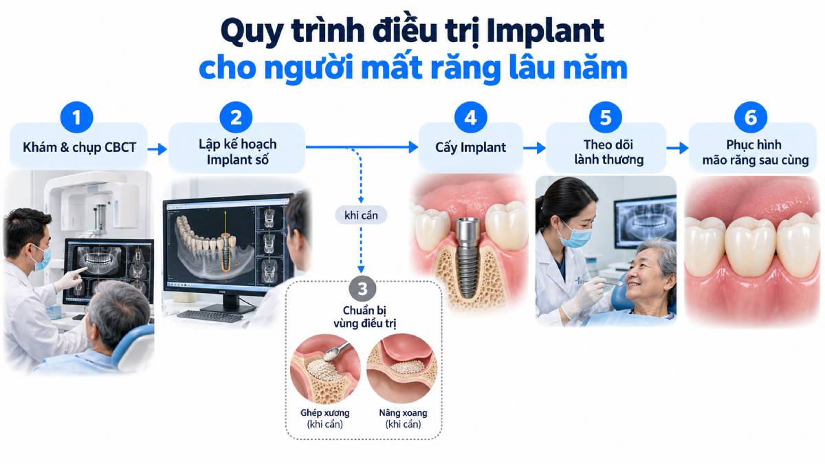 Các giai đoạn từ đánh giá đến phục hình Implant ở người mất răng lâu năm